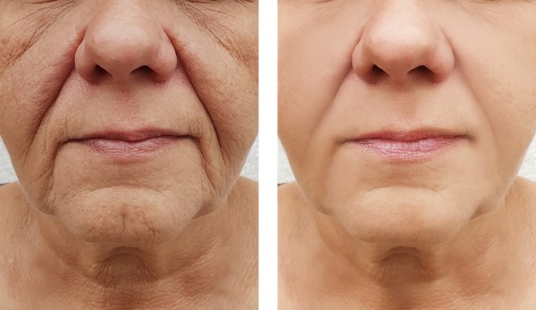 Learn more about Morpheus8 Treatment Hatfield today!