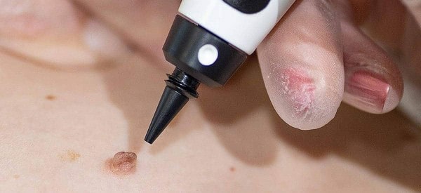 After Skin Tag Removal Hatfield