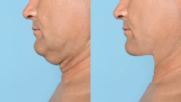 Which Non-Surgical Treatments Work Best for Jowls and Loose Skin Hatfield?