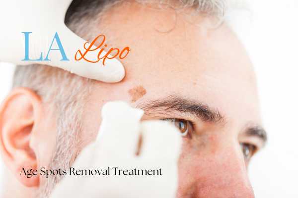 What Are the Most Effective Treatments for Age Spots Hatfield?