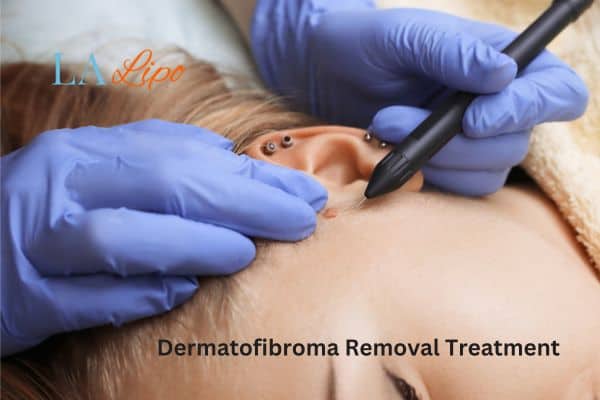 Dermatofibroma Removal Treatment Hatfield