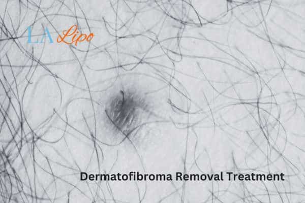 Dermatofibroma