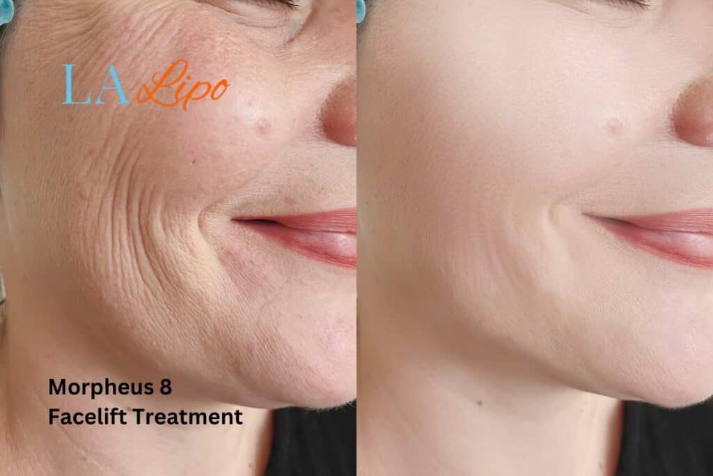 Morpheus8 Treatment Hatfield for flawless skin! Call us today!