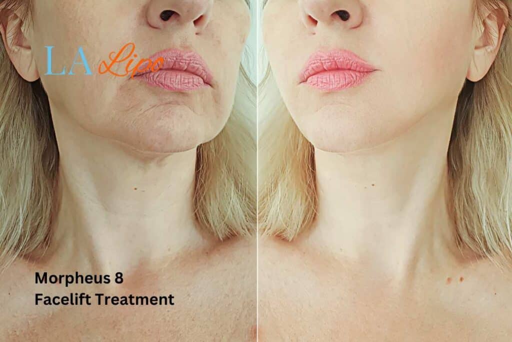 Turn back time with Morpheus8 Treatment Hatfield