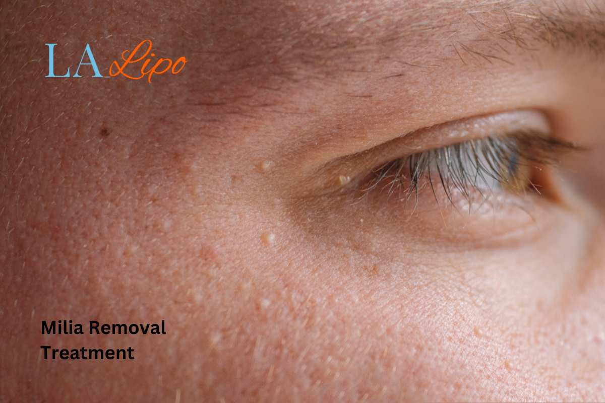 Cryopen Milia Removal: Is It the Easiest and Safest Option Hatfield?