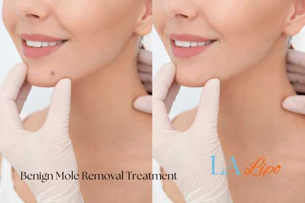 Before-and-after results following benign mole-removal treatment Hatfield