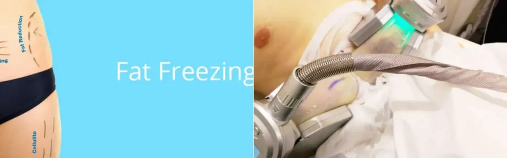 Fat freezing Hatfield on multiple areas of the body