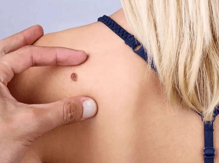 woman having mole removal Hatfield consultation before treatment.