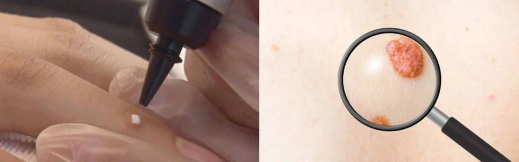 CryoPen practitioner Hatfield assessing a benign mole before treatment