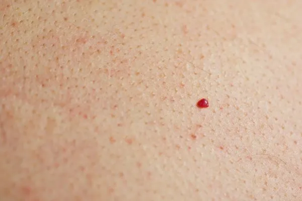 close up of a cherry angioma Hatfield