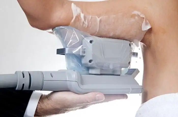 Picture of fat freezing Hatfield on the upper arms.