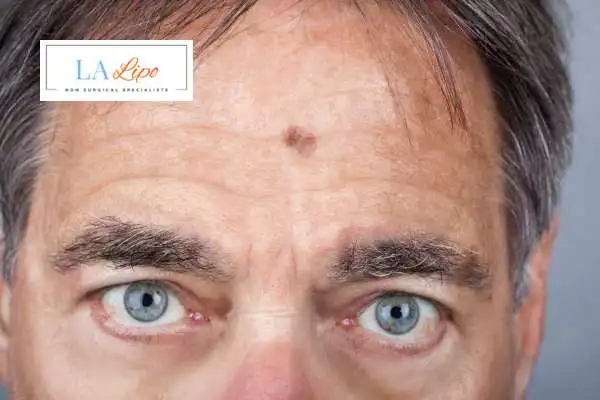 Solar Lentigo Removal Hatfield image of man with mark on his forehead