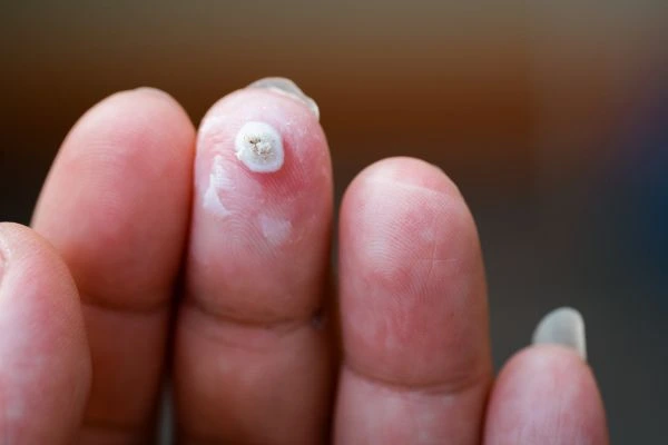 wart on person finger - cryotherapy to treat from LA LIPO Hatfield