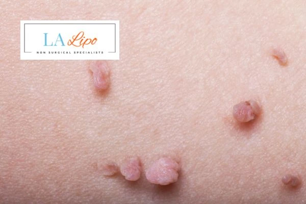 Does cryopen skin tag removal Hatfield hurt? Find out now call our team today!