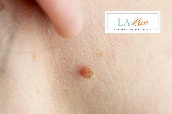 Book skin tag removal Hatfield today speak to our team now!