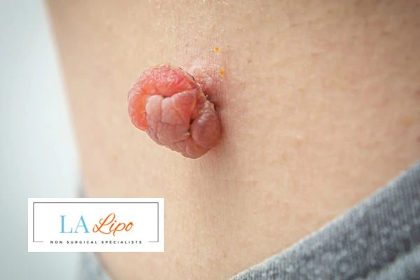 Interested in skin tag removal Hatfield? Concerned about the pain? Find out more today!