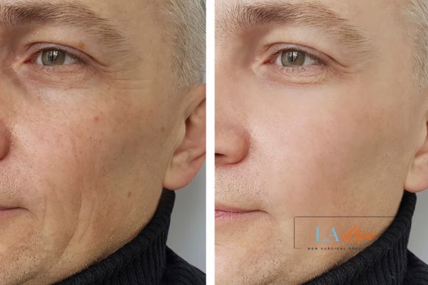 See the amazing results of Morpheus8 Treatment Hatfield!