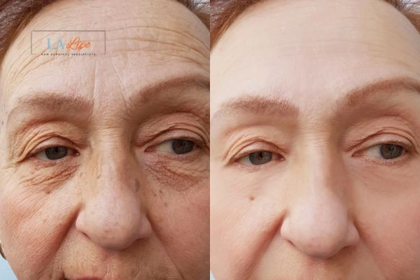The powerful benefits of Morpheus8 Treatment Hatfield - Call Our team today!