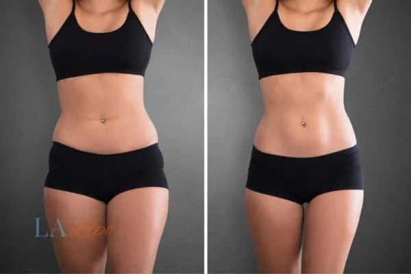 before and after results of non-surgical treatment to help a woman's body image and mental health Hatfield