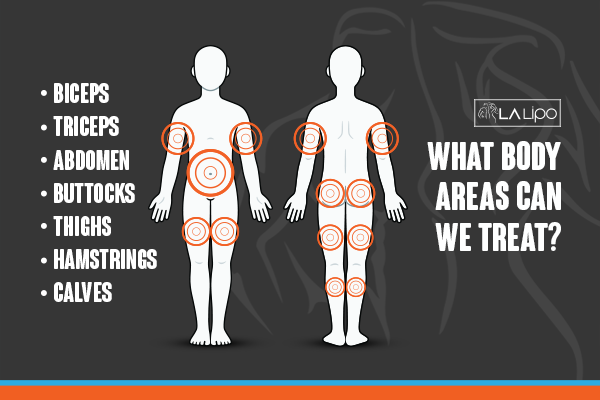 Diagram to show areas you can have LA-EMS Body Sculpting Treatment Hatfield