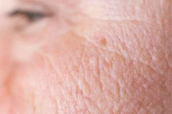 close up picture of a woman's face showing an age spot Hatfield
