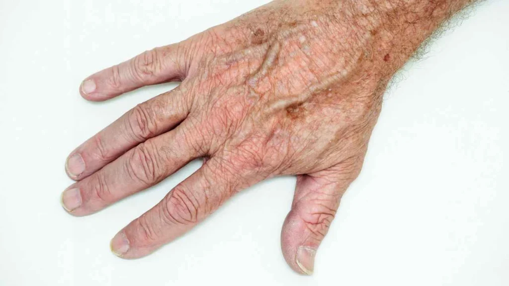Male hand showing age spot Hatfield