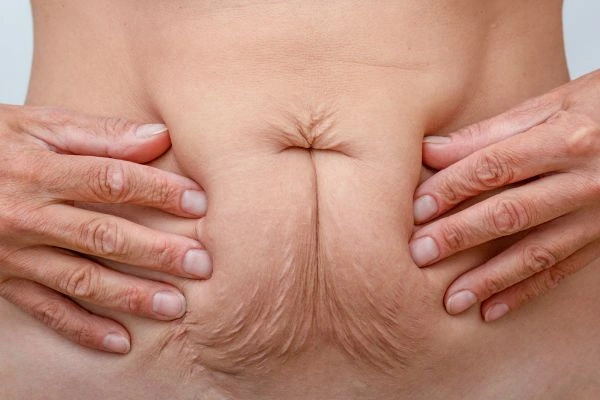Should I Combine Diastasis Recti Treatment with Body Contouring for Better Results Hatfield?