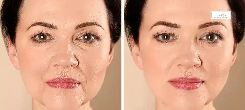 How Long Does It Take to See Results and How Long Do They Last Hatfield?
