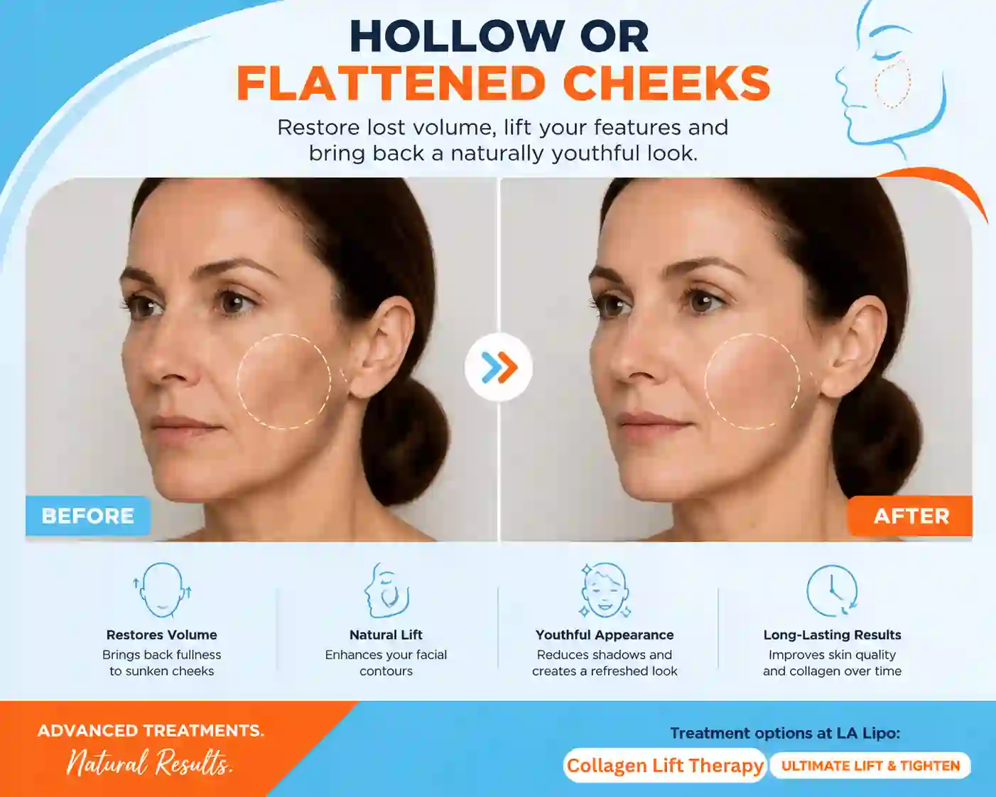 Sign #4: Hollow or Flattened Cheeks Hatfield
